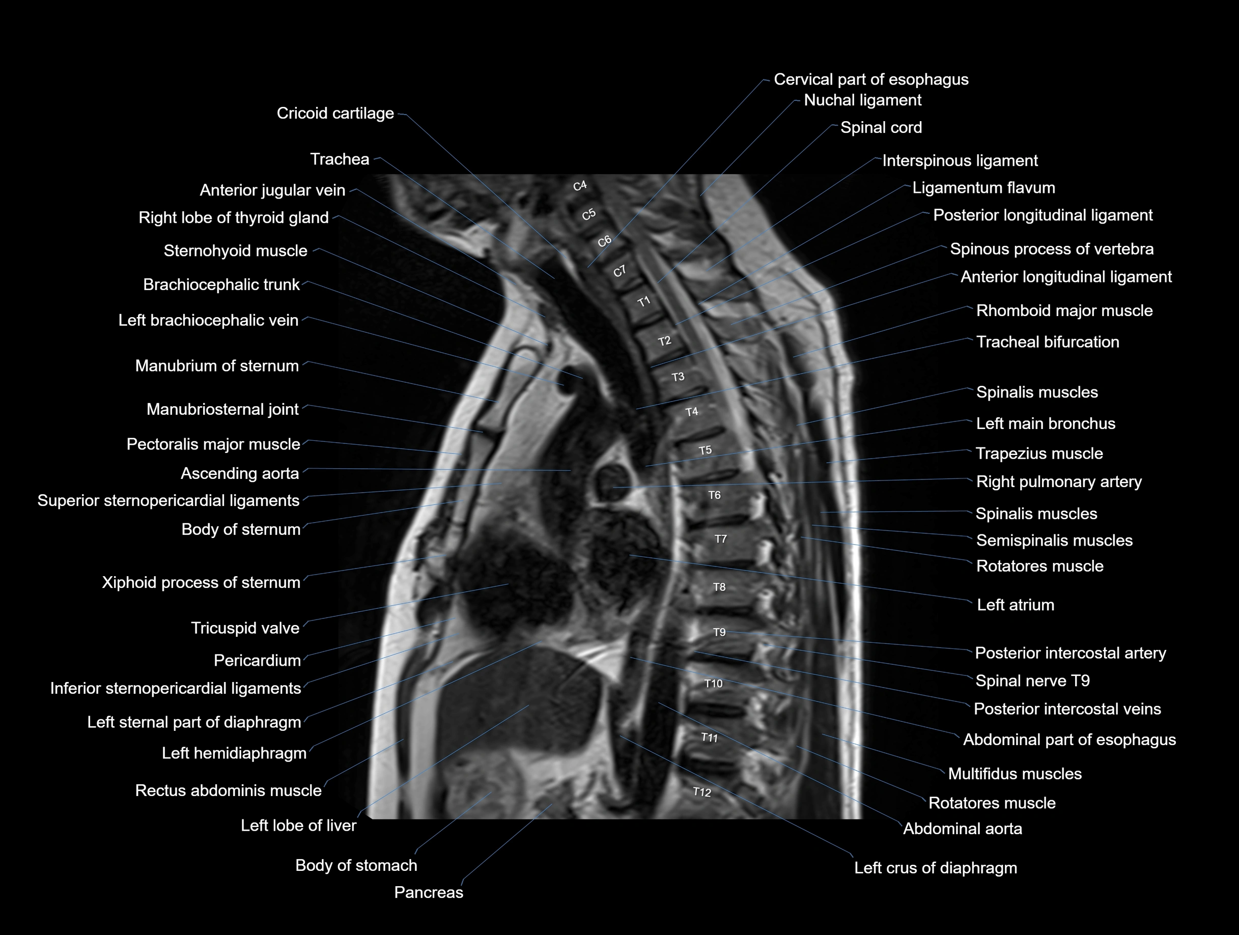 MRI chest (thorax) coronal  cross sectional anatomy 3T radiology  image-img-00001-00020.webp